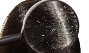 Thay đổi thói quen chăm sóc tóc và da đầu để giảm gàu