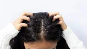 Nhận diện gàu và các nguyên nhân gây ra gàu